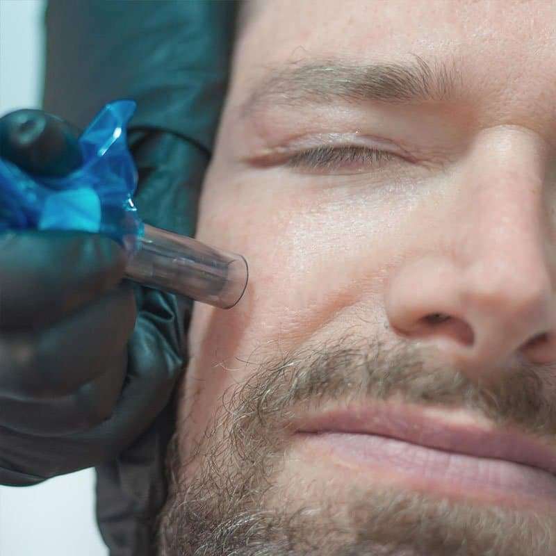 Microneedling treatment performed on a male client's face