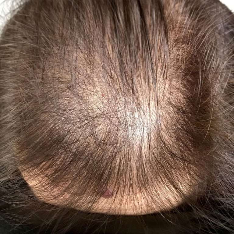 Top view of scalp micropigmentation density restoration on thinning hair