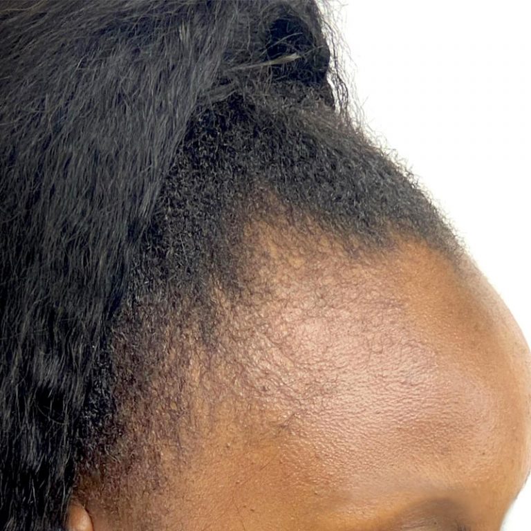 Scalp micropigmentation hairline restoration shown on a client's side profile