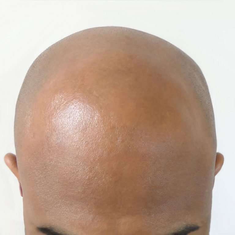 Back view of scalp micropigmentation full coverage on a man's bald head