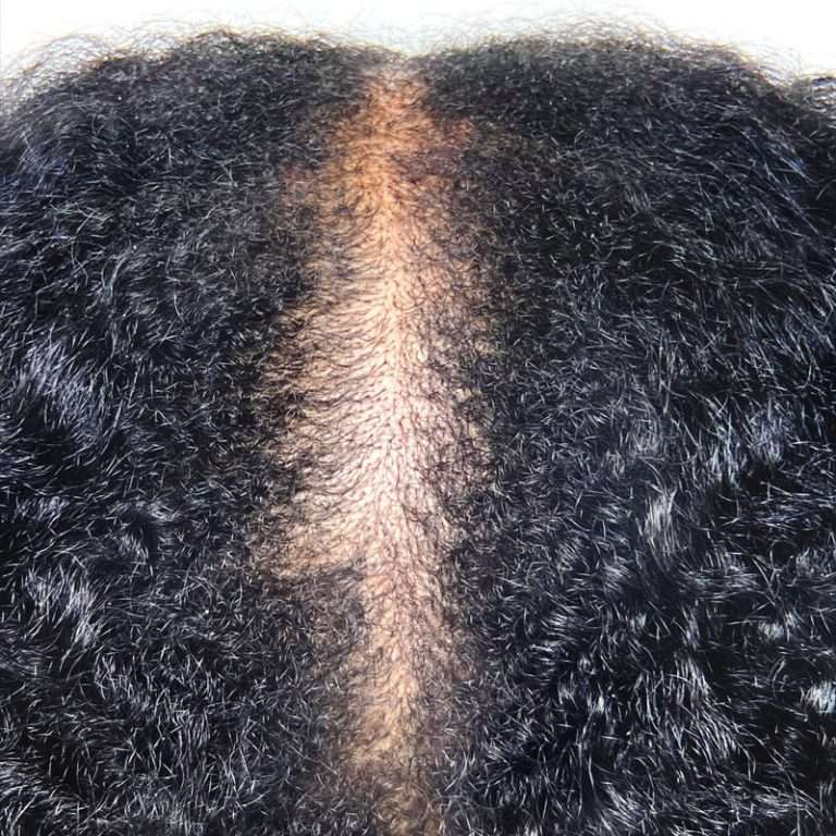 Scalp micropigmentation part line adding density to thinning dark hair