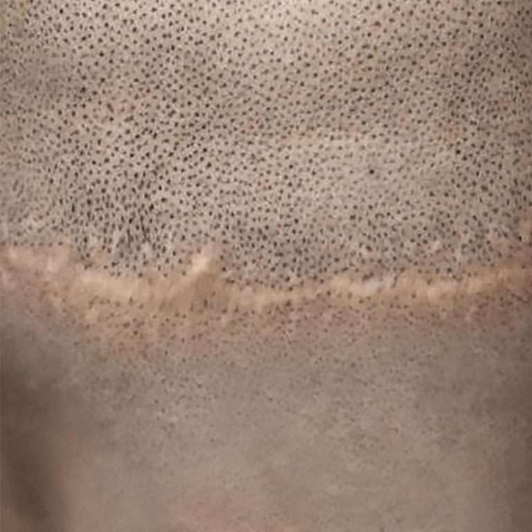 Scalp micropigmentation scar camouflage blending dots into a hair transplant scar