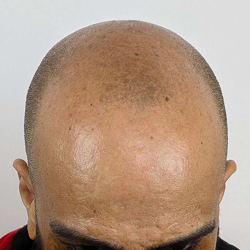 Scalp micropigmentation result on a man's head