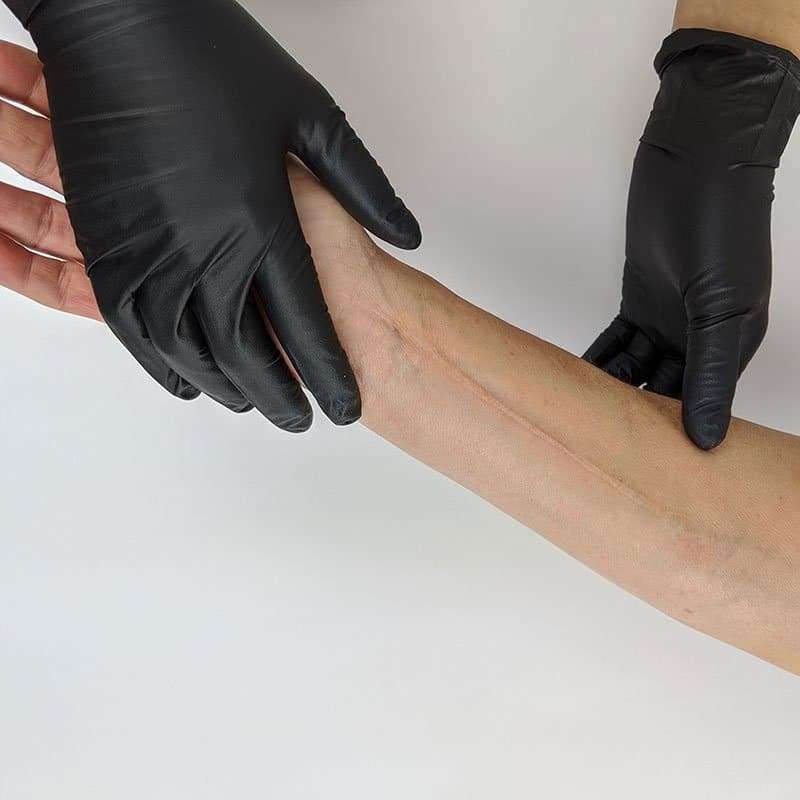 Gloved artist examining a client's arm for scar revision treatment