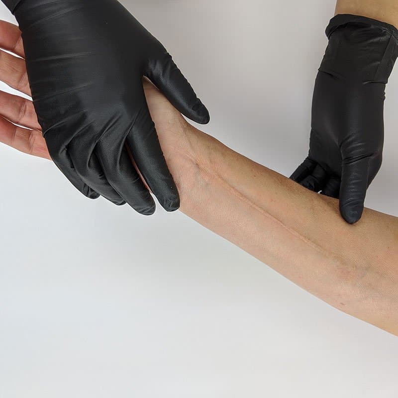 Gloved artist examining a client's arm for scar revision treatment