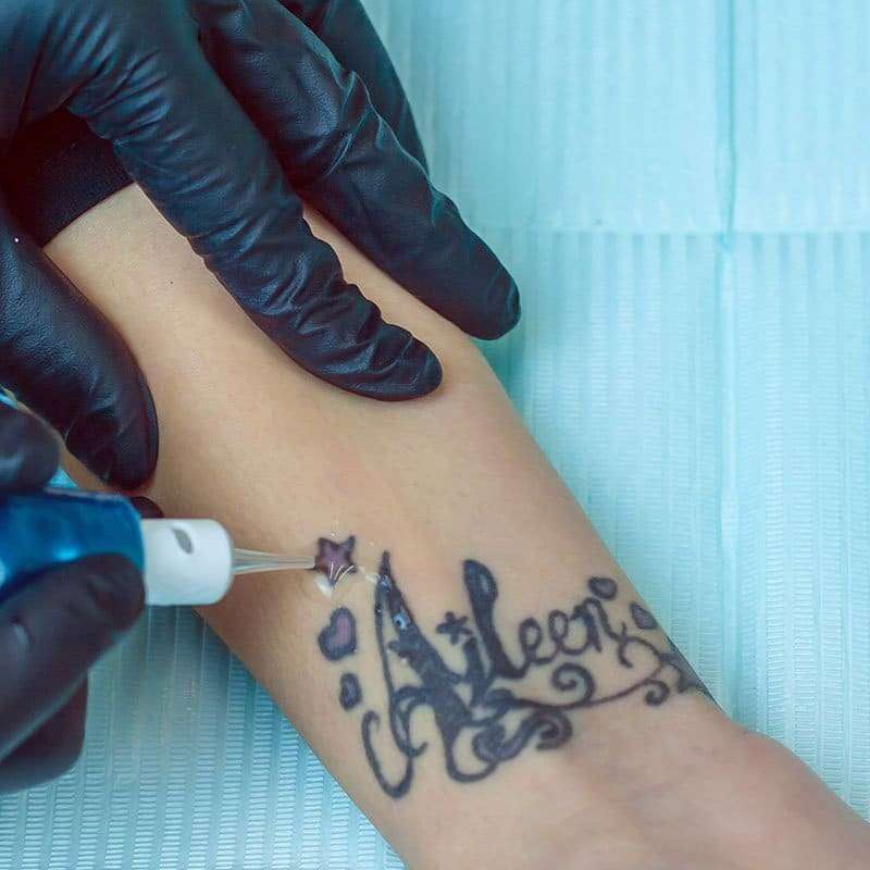 Laser tattoo removal treatment on a client's wrist tattoo