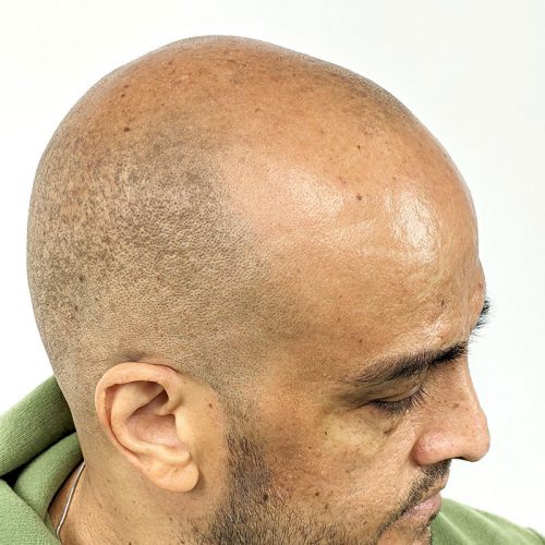 Scalp micropigmentation rH827esult on a man's head shown in side profile