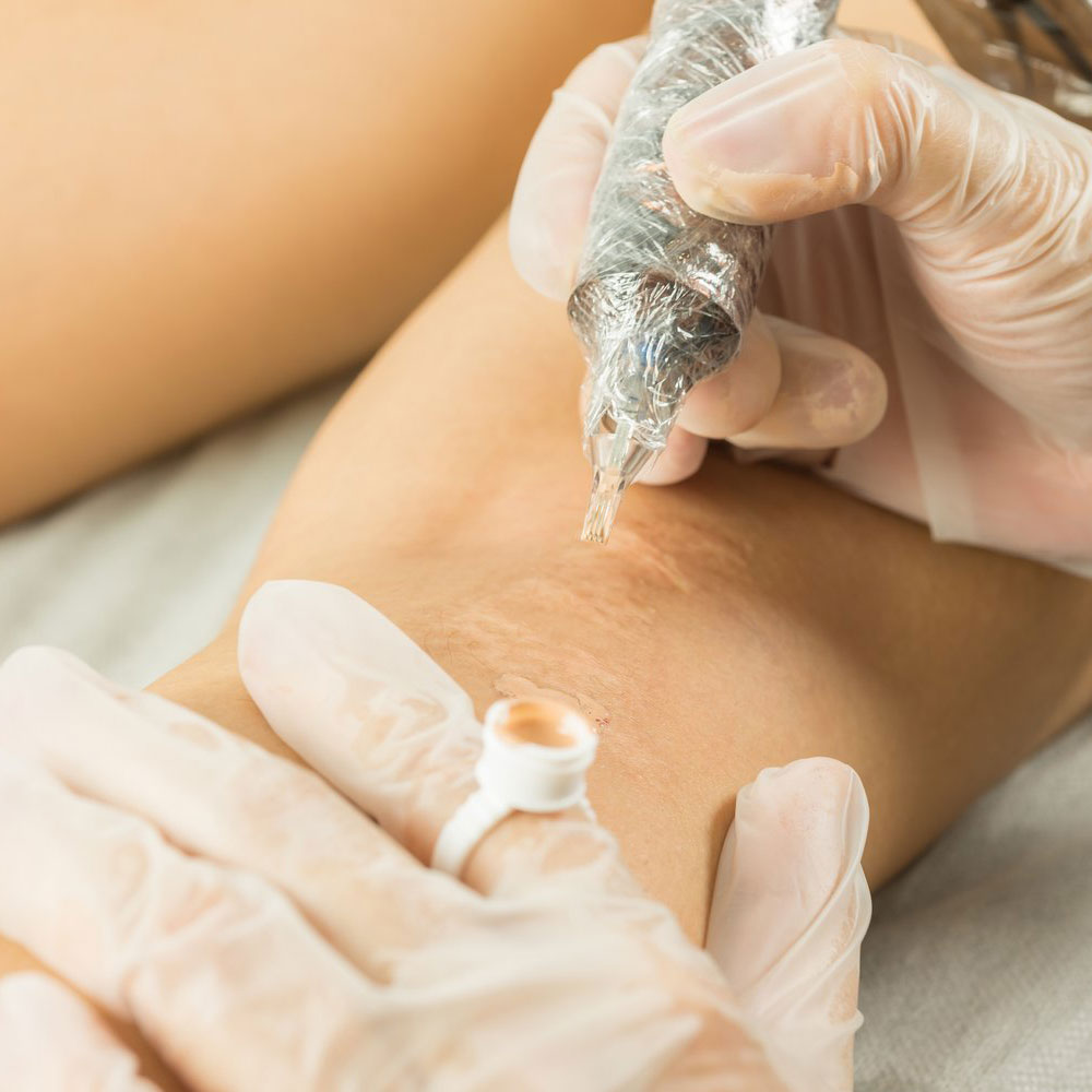 Gloved permanent makeup artist performing a scar camouflage tattoo on a client's skin