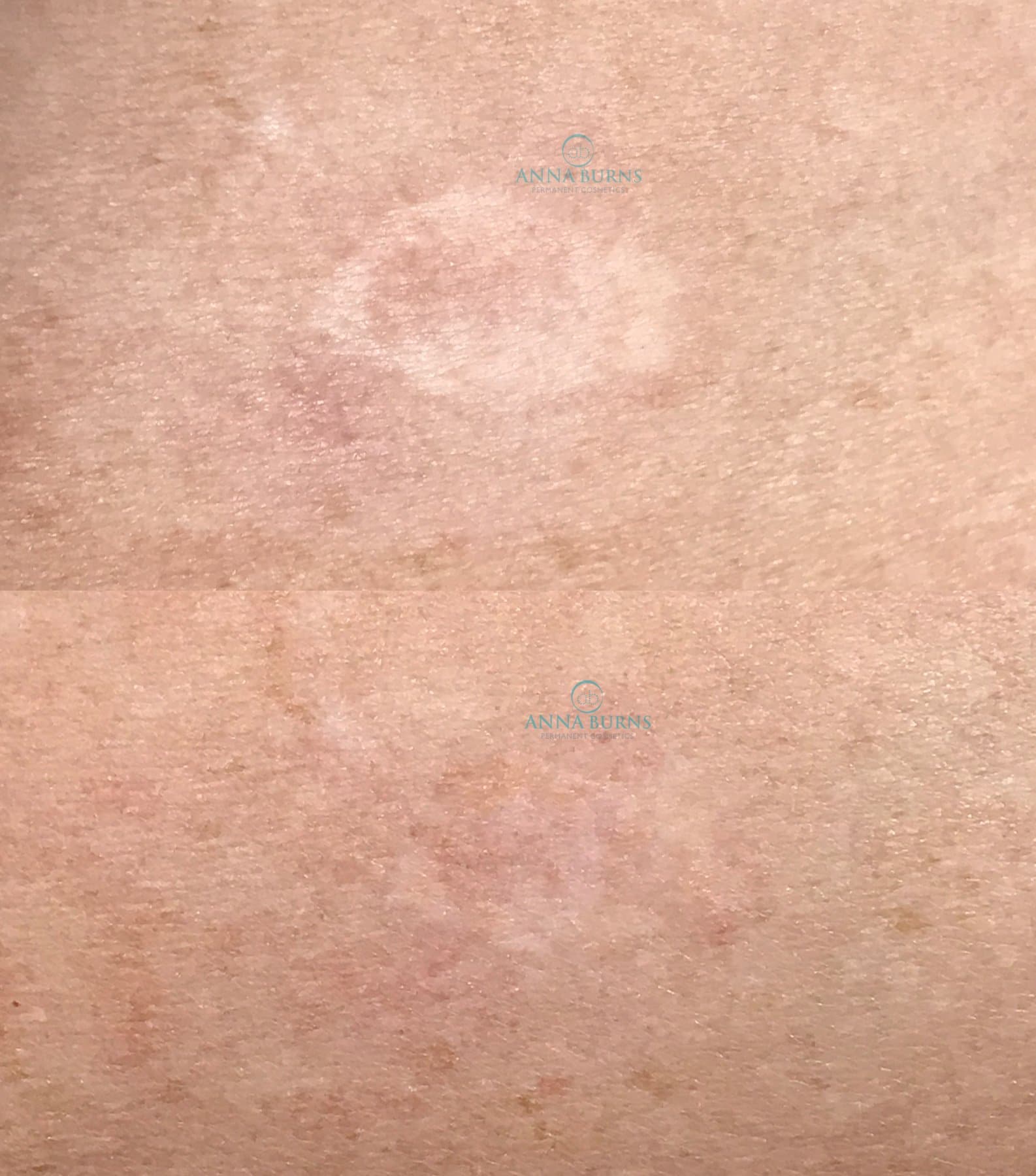 Scar Camouflage Tattoo – Permanent Scar Tattoo Before and After