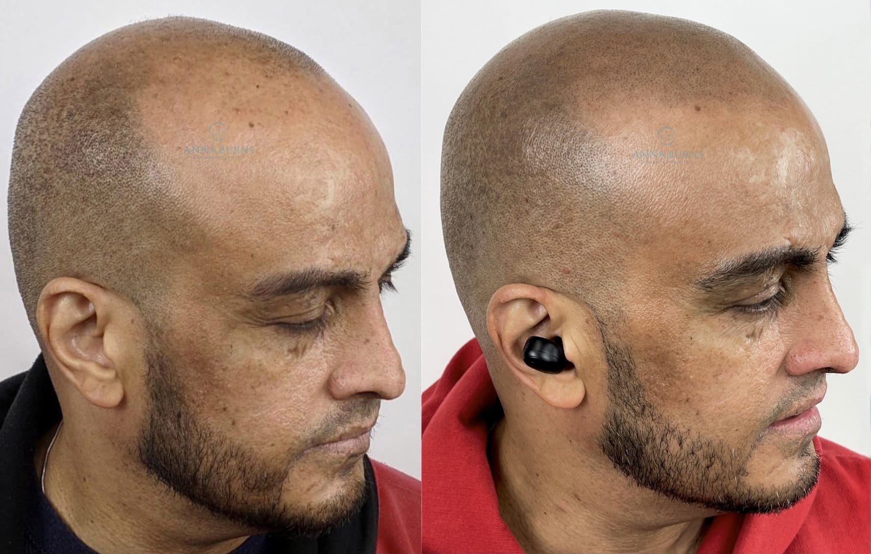 Scalp Micropigmentation – SMP Hair Loss Treatment Before and After
