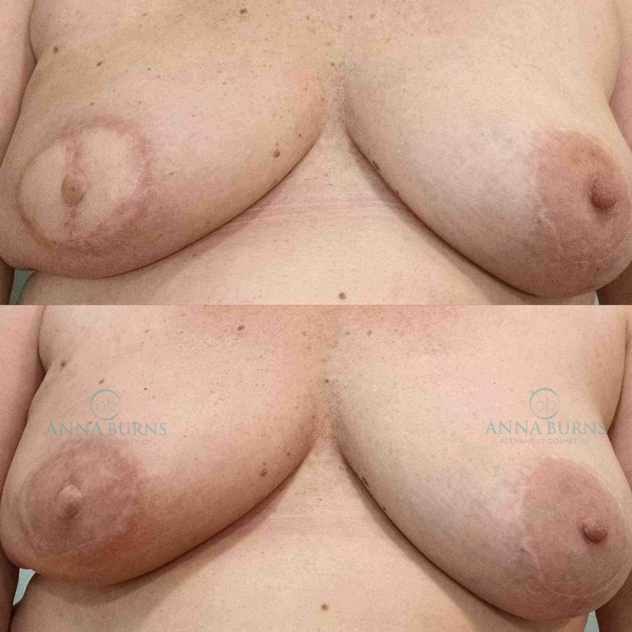 What to Expect During Your 3D Areola Tattoo Appointment